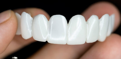 Snap-On Cosmetic Veneers