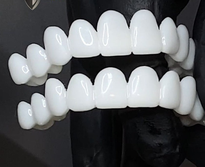 Snap-On Cosmetic Veneers