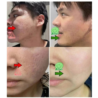 Acne Scar Repair Cream for Pores, Blackheads, and Skin Smoothing