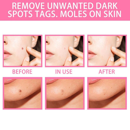 All-Natural Skin Tag and Mole Removal Serum, Herbal Formula