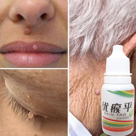 Skin Tag Mole Wart Remover