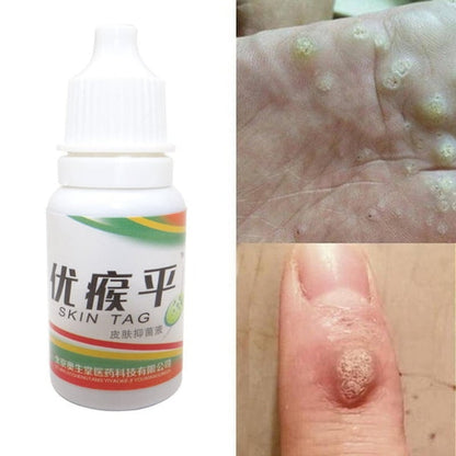 Skin Tag Mole Wart Remover